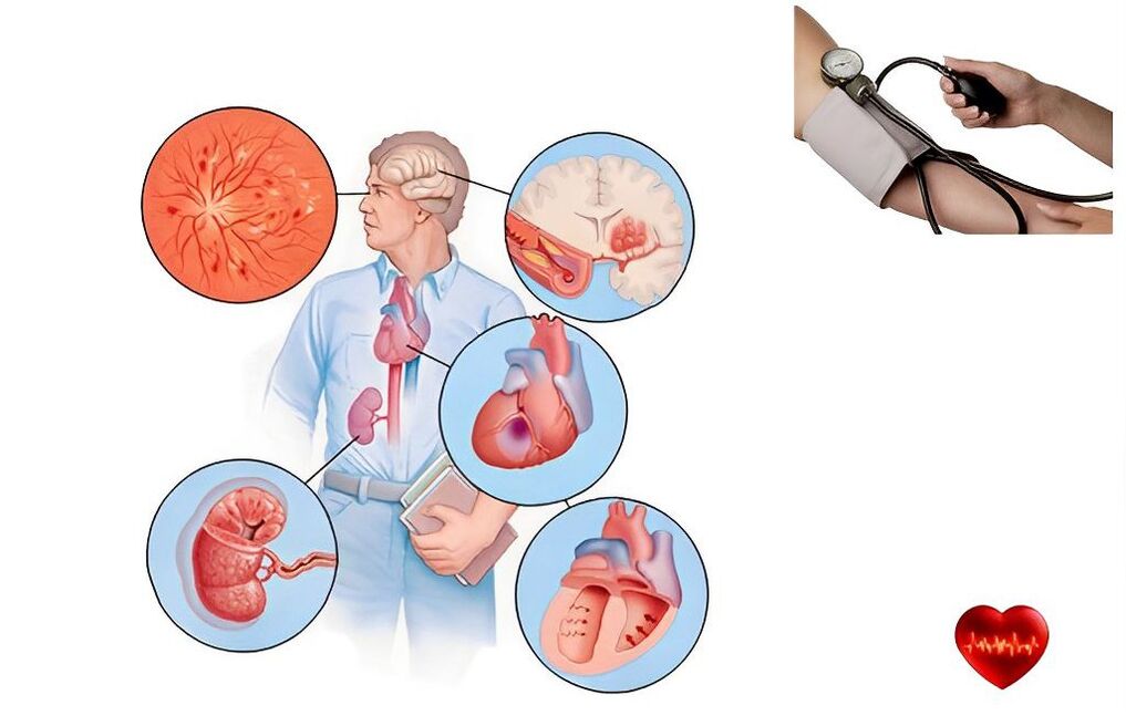 Hipertens O Arterial Hipertens O Causas Sinais Tratamento Por Que